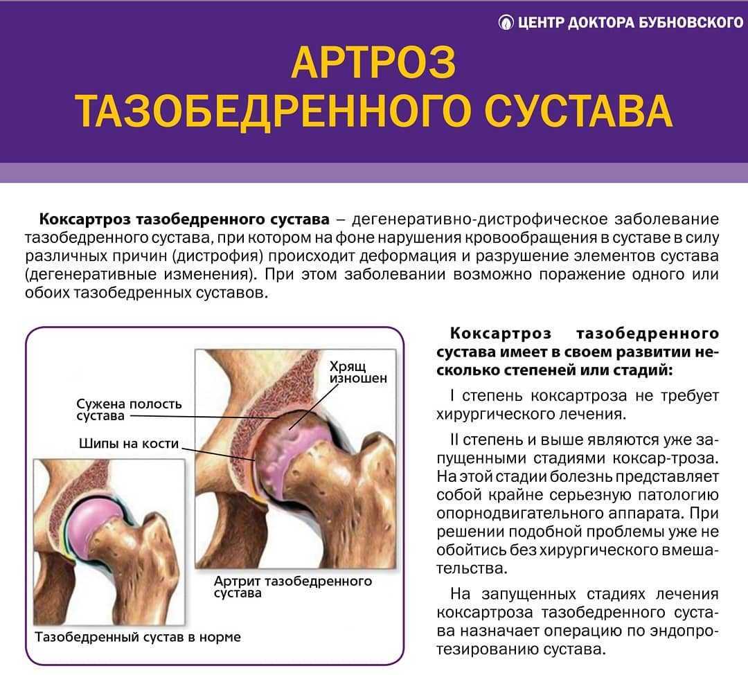 Артроз суставов: лечение, симптомы. степени артроза.