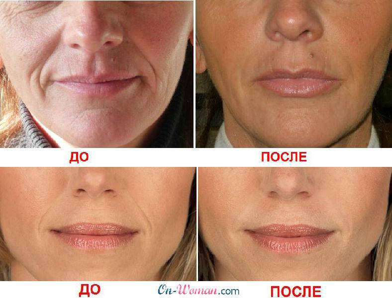 Мезотерапия или биоревитализация - что лучше, отличия процедур | expert clinics