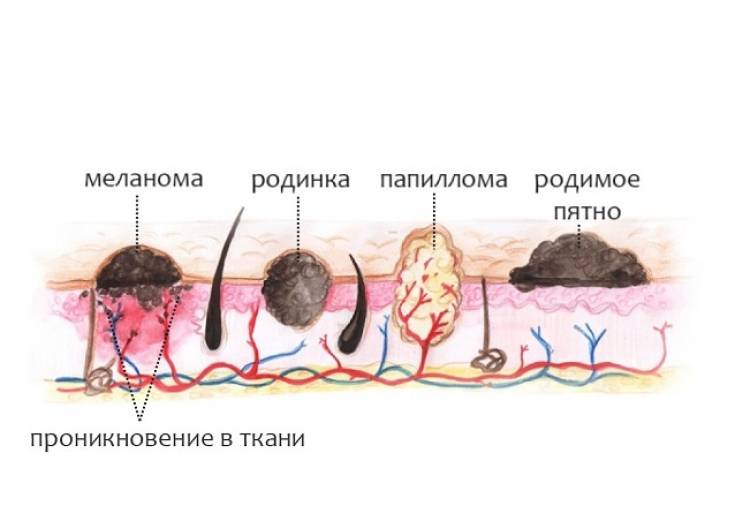 Как отличить родинку от папилломы: чем они отличаются?