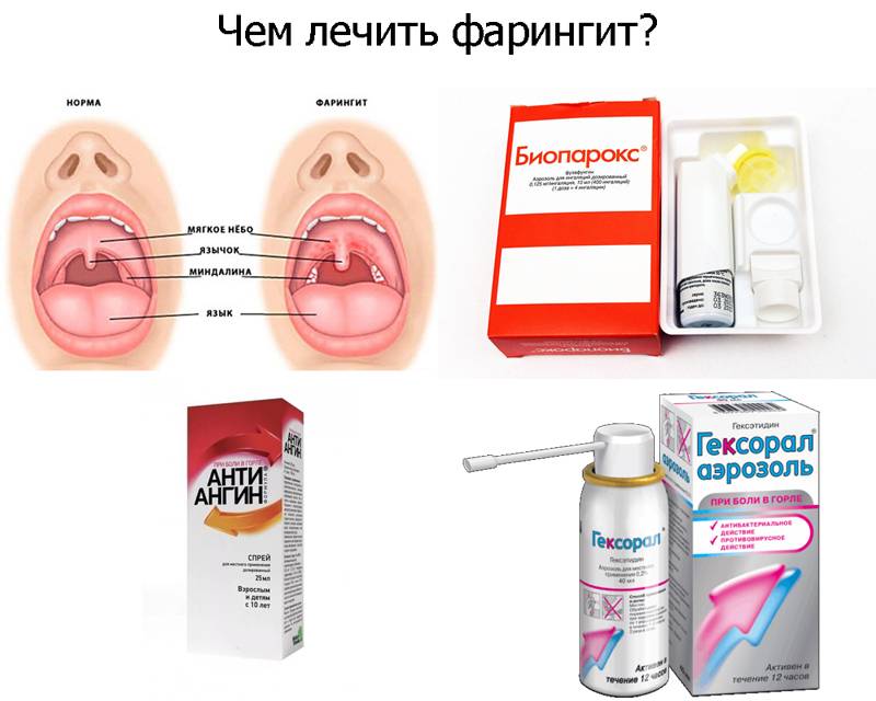 Чем отличается фарингит от тонзиллита, особенности лечения тонзиллита и фарингита | стоматология-элит.рф