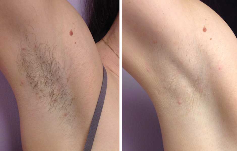 Что лучше: электроэпиляция, фотоэпиляция или лазерная эпиляция?