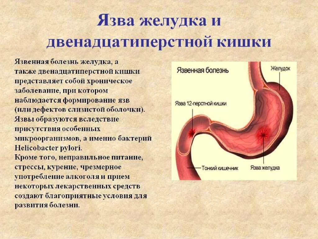 Как отличить гастрит от язвы? учимся по внешним симптомам отличать гастрит от язвенной болезни