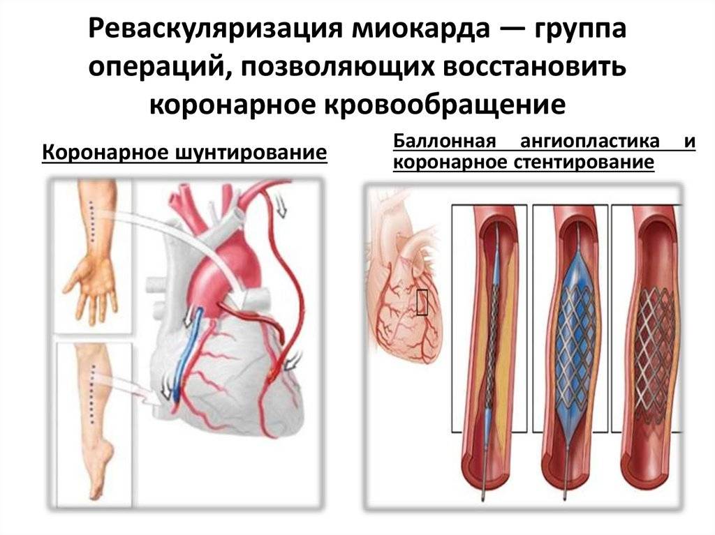 Стентирование сердца: описание операции, ее достоинства, реабилитация