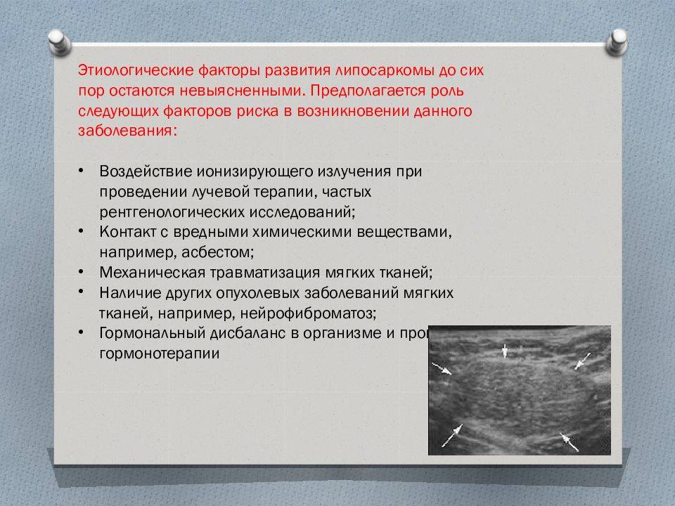 Саркомы мягких тканей